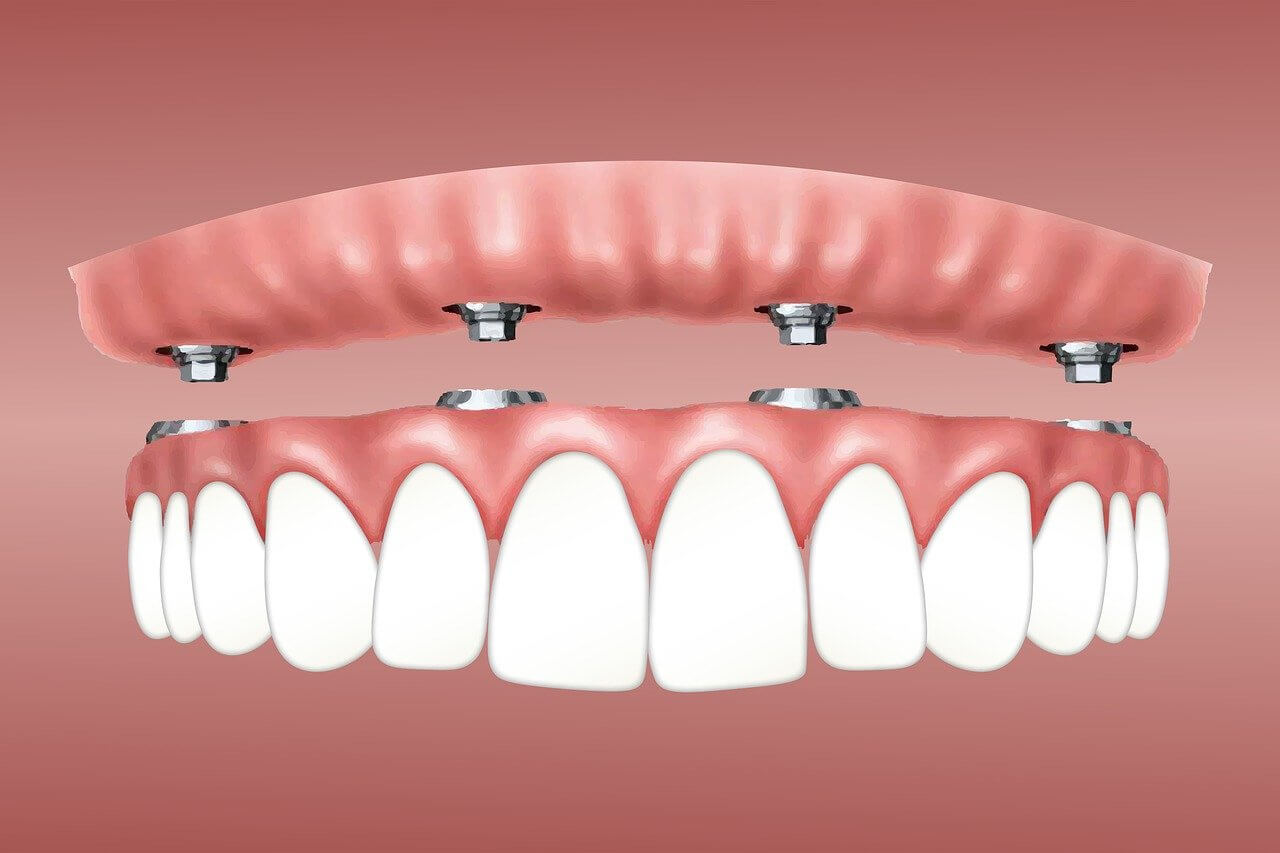 All-on-4 Dental Implant Image