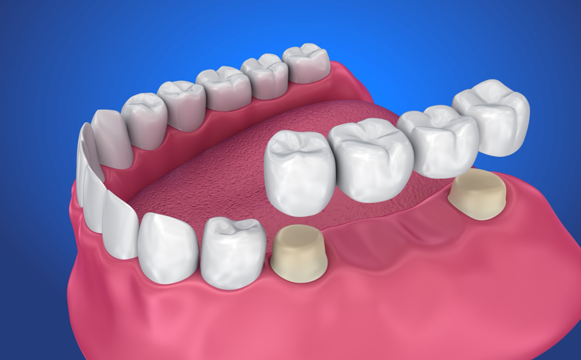 Dental Bridge Image