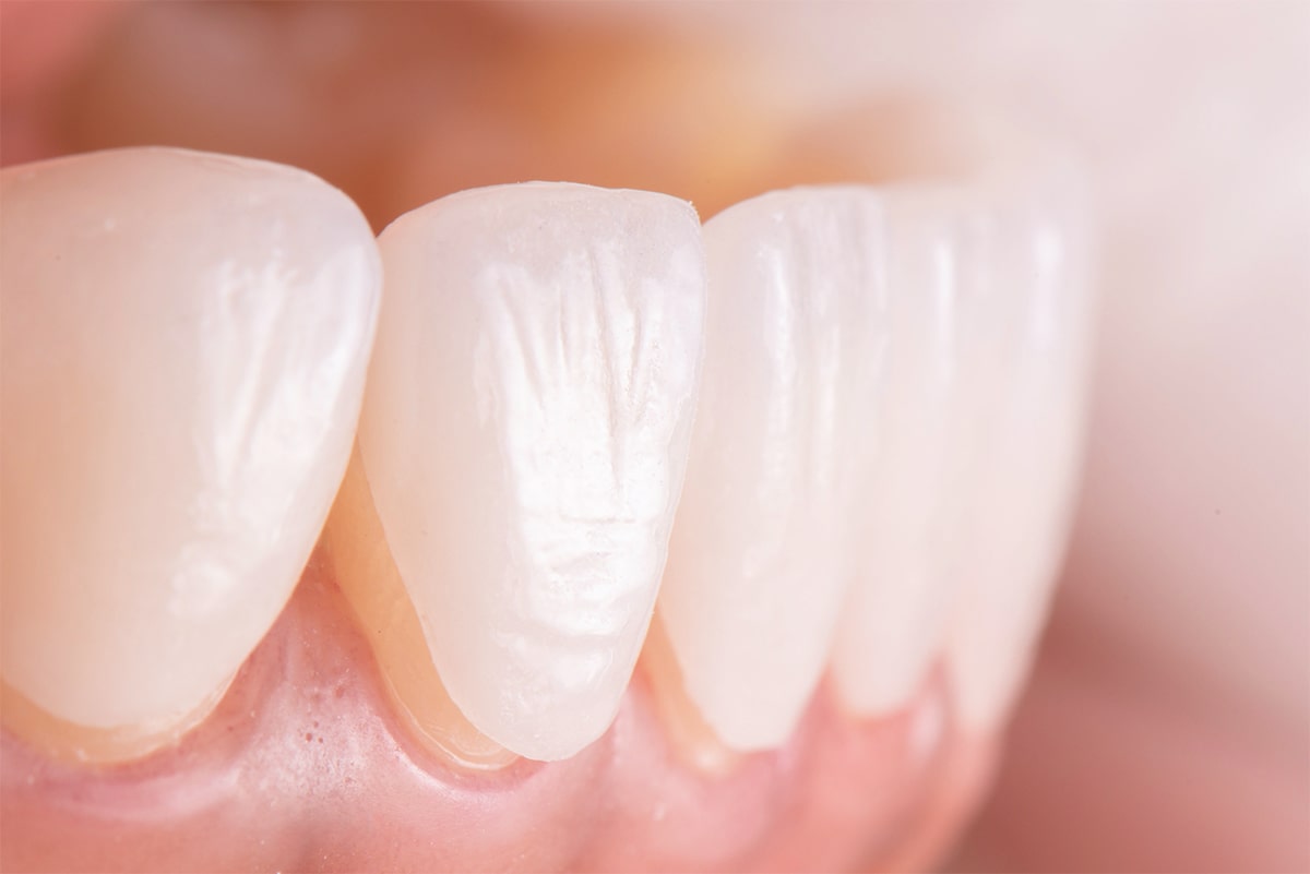 E.MAX Veneers Image
