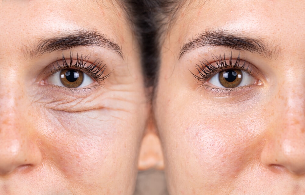 Eyelid Surgery Blepharoplasty in Turkey