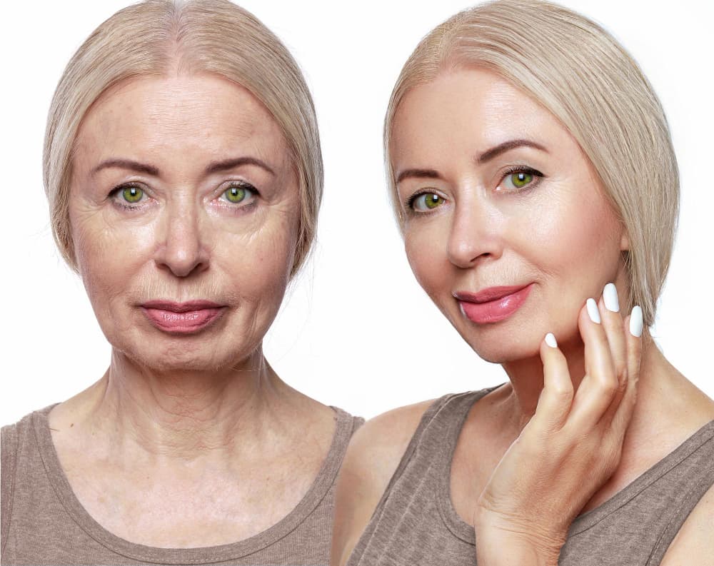 Face Lift Surgery in Turkey