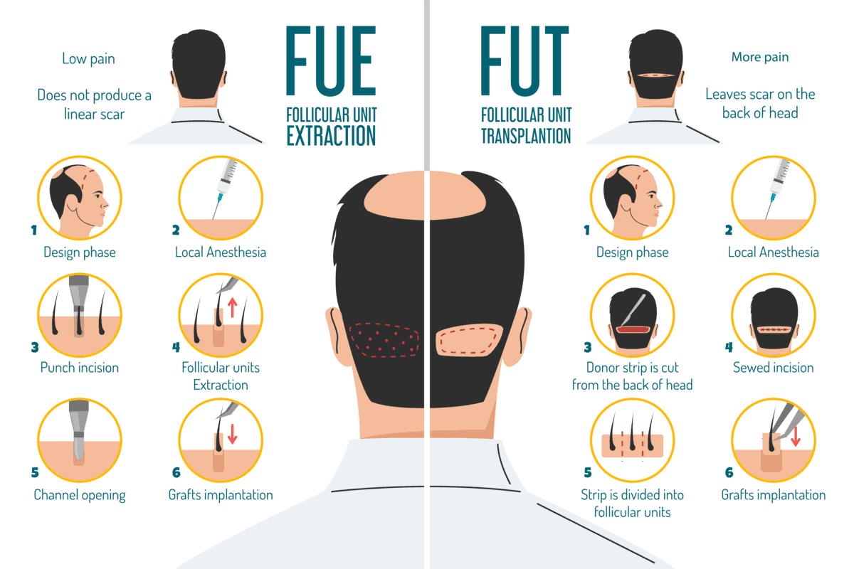 FUT Hair Transplant in Turkey