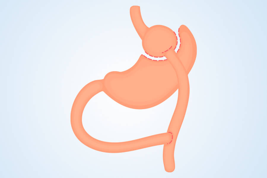Gastric Bypass Surgery in Turkey