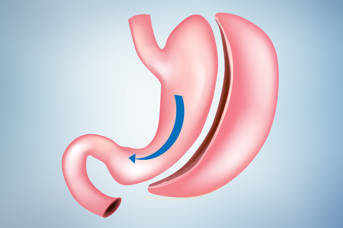Gastric Sleeve Surgery in Turkey