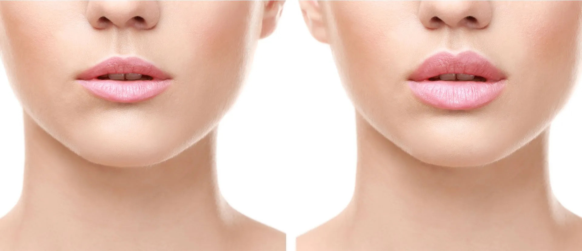 Lip Filler Treatment in Turkey