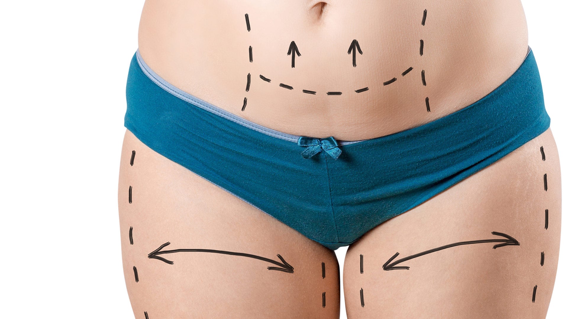 Liposuction Surgery in Turkey