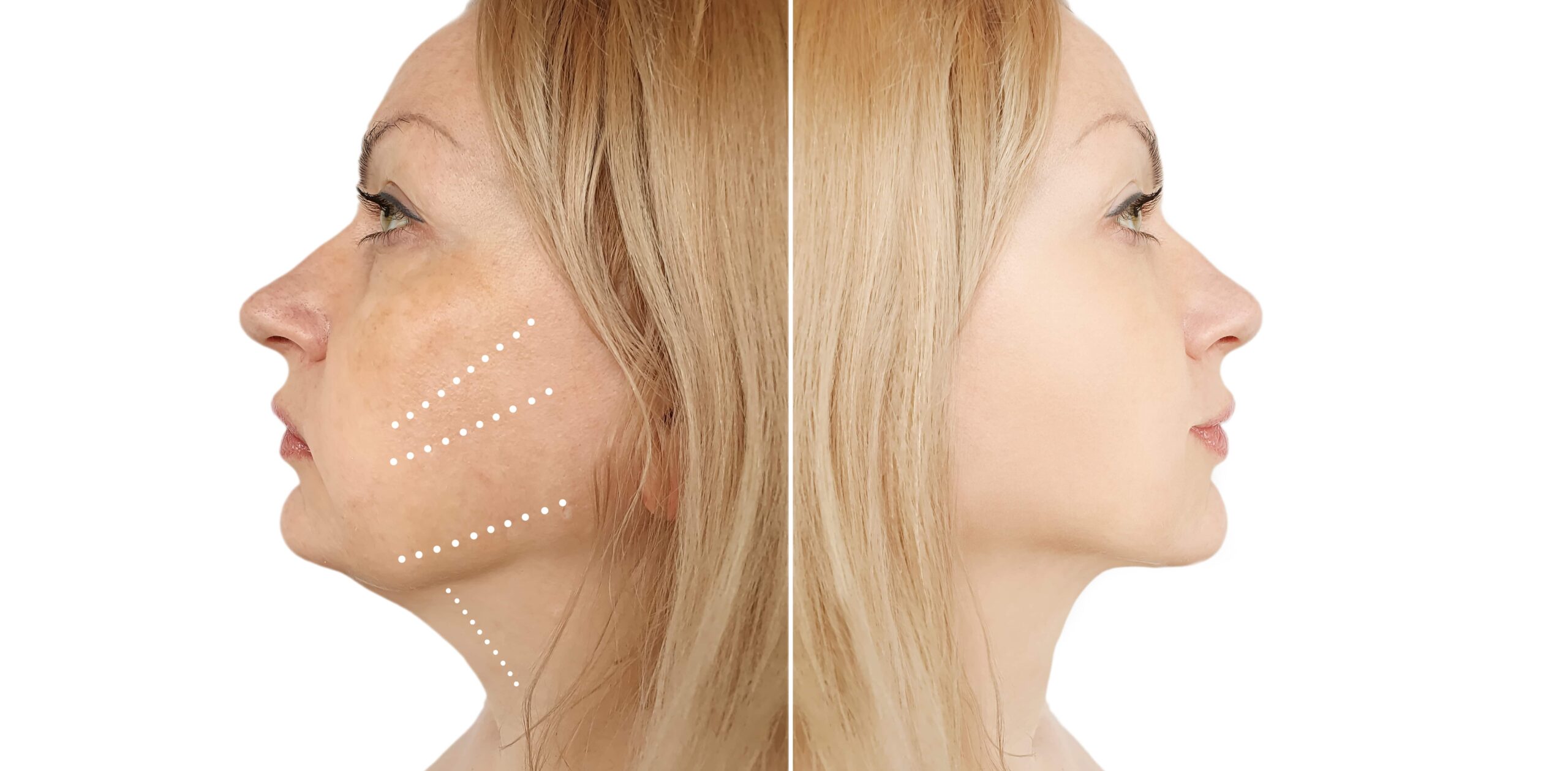 Neck Lift Surgery in Turkey