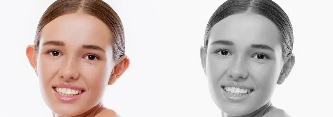 Otoplasty Ear Surgery in Turkey