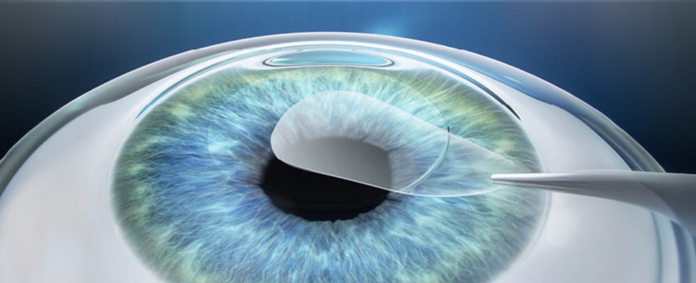 ReLEx SMILE Treatment Image