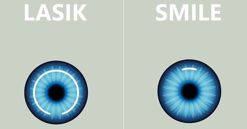 ReLEx SMILE Machine Image