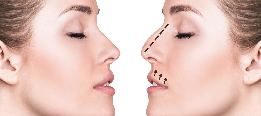Rhinoplasty Nose Surgery in Turkey