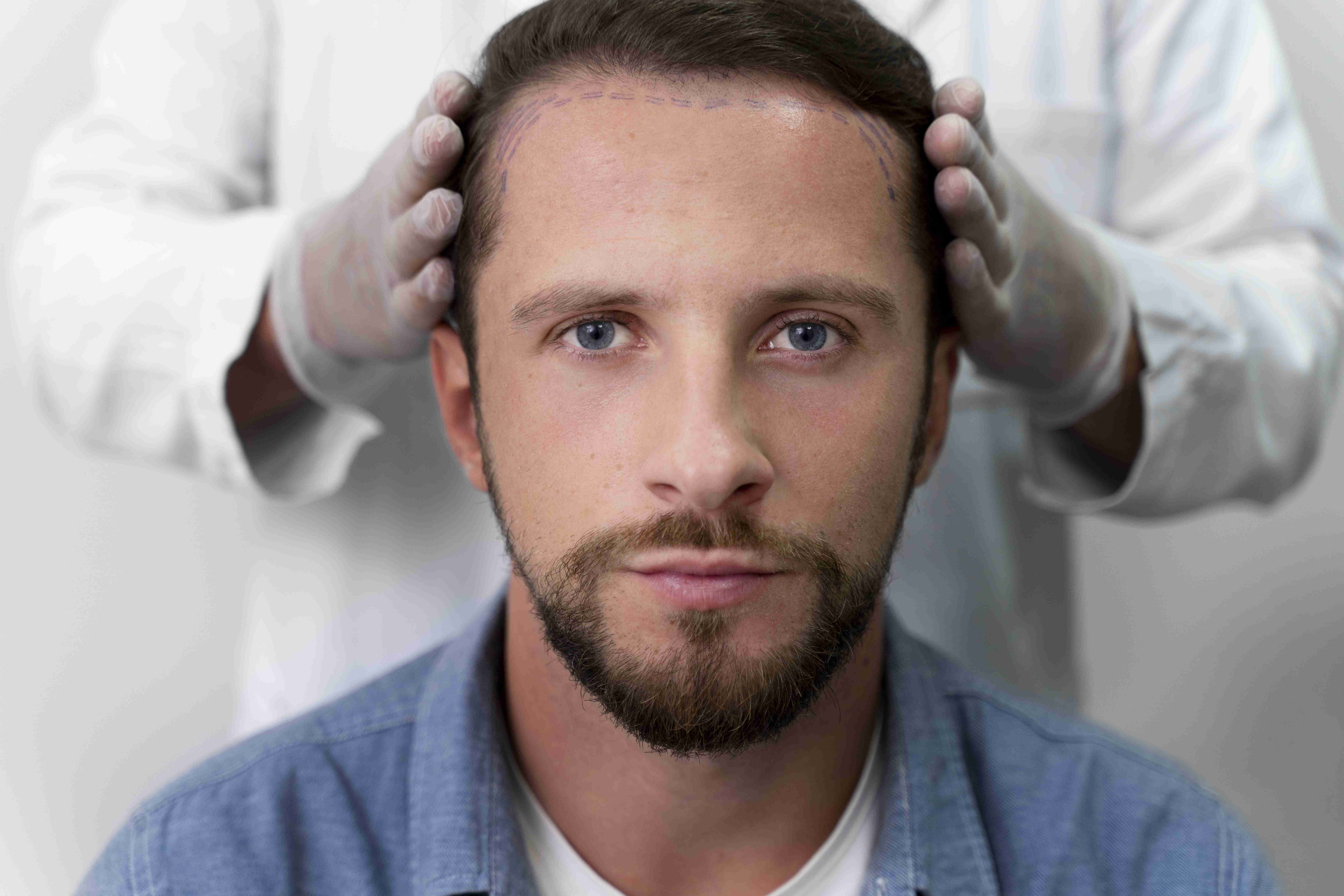 Hair Transplant in Turkey