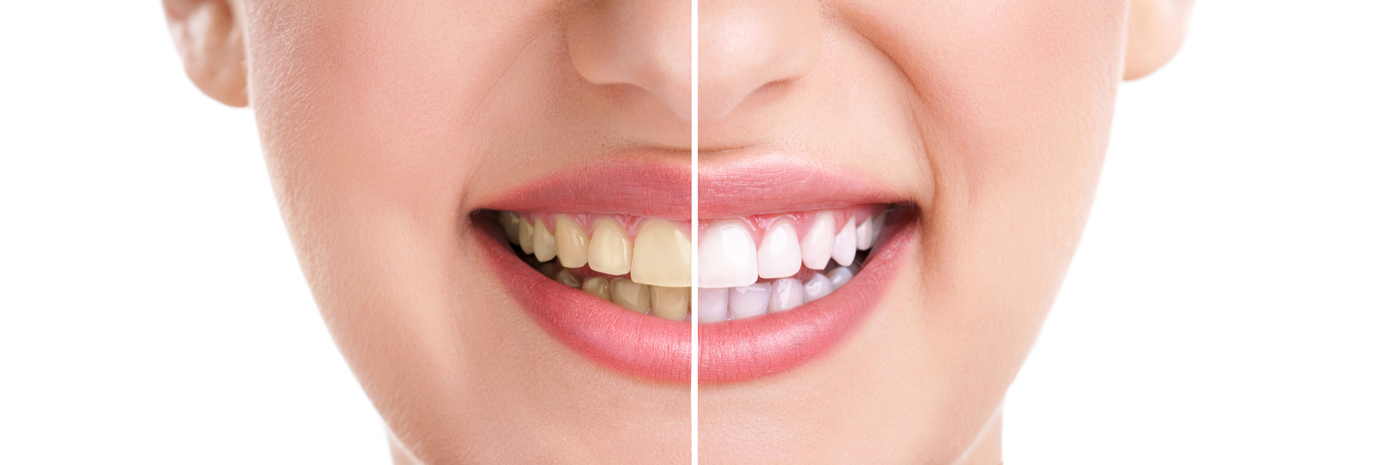 Teeth Whitening Image